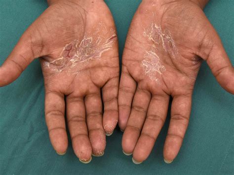 Hand Eczema About And Treatments