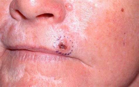 Basal Cell Carcinoma Basal Cell Skin Cancer Rochester Hills