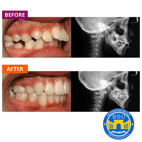 Invisalign Before And After Overjet