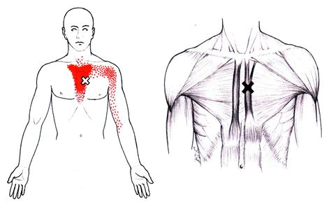 Sternalis The Trigger Point And Referred Pain Guide
