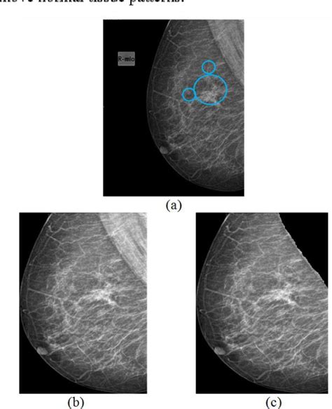 Figure 1 From Detection Of Architectural Distortion In Mammogram