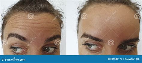 Woman Forehead Wrinkles Before And After Treatment Stock Image Image