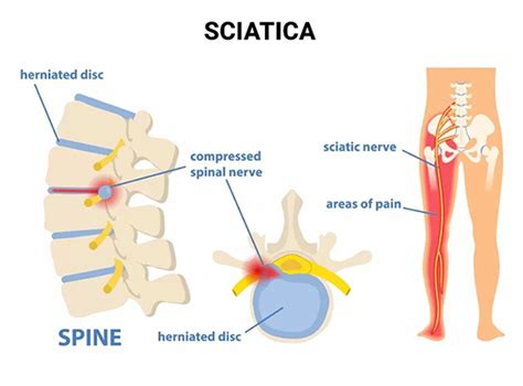 Sciatica Pain Immediate Relief Cure Sciatica Permanently NJ S Top