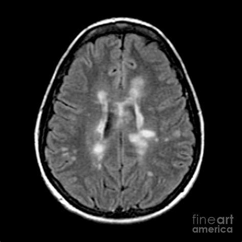 Mri Of Multiple Sclerosis Photograph By Medical Body Scans