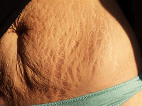 Flaws And All Stretch Marks Go Viral In Support Of Women