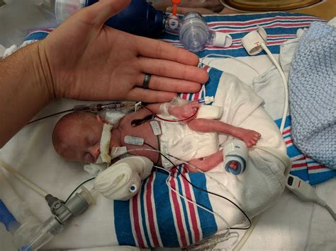 ‘miracle Baby One Of The Smallest Premature Infants Ever Heads Home