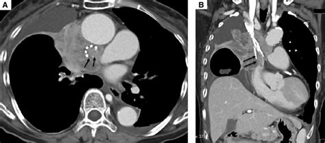 Contrast Enhanced Computed Tomography Ct Images Of The Thorax In The