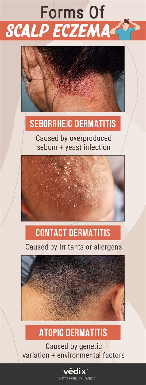 Scalp Eczema Causes Symptoms Treatments And Preventive Tips Vedix