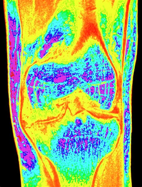 Colour Mri Scan Of Knee Joint With Osteoarthritis Photograph By Simon