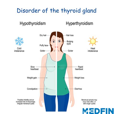 Cómo Saber si Tengo Hipertiroidismo o Hipotiroidismo Todos Desde Cero