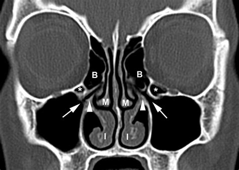 Paranasal Sinuses Sinusitis Ct Scan