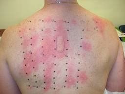 We did not find results for: Food Allergy Skin Tests ~ Medical Health Information