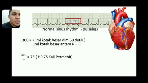 Rumus Menghitung Heart Rate Dari Hasil Ekg Youtube