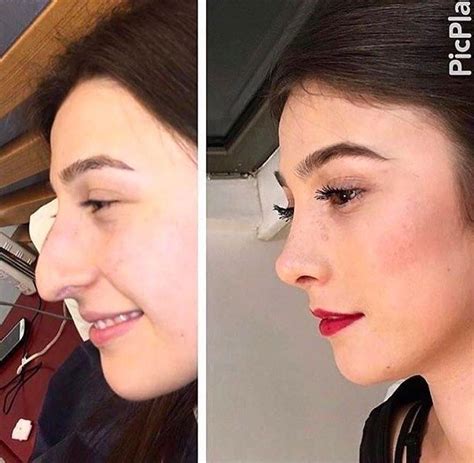 Possibly The Best Nose Job I Ve Ever Seen Nose Job Nose Surgery Pretty Nose
