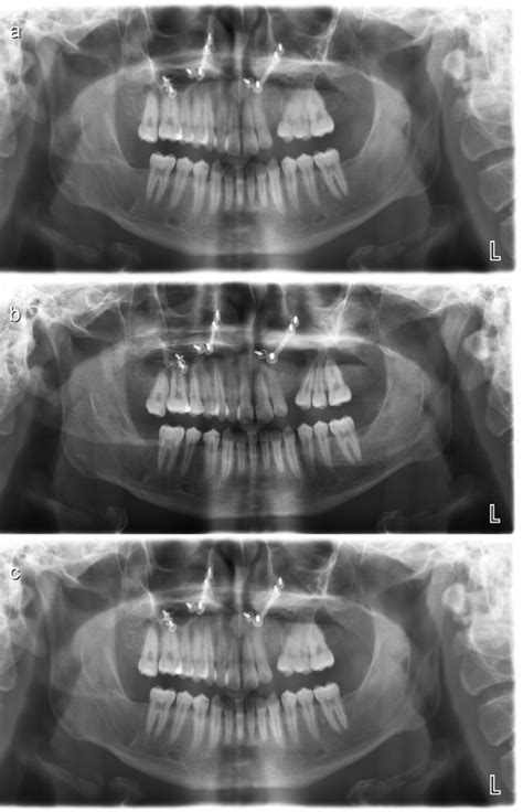 A Panoramic Radiograph Six Months Post Surgery For The Removal Of The
