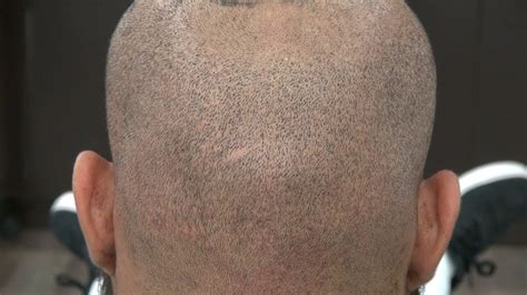 Fue Scar On Black Client 1 Year Follow Up Hair Transplant Surgery Dr