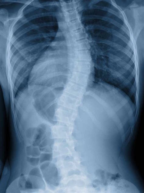 Scoliosis Treatment In Plano And Frisco Tx American Neurospine