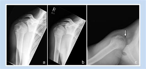 Figure From Subscapularis Tears And Lesser Tuberosity Avulsion Fractures In The Pediatric