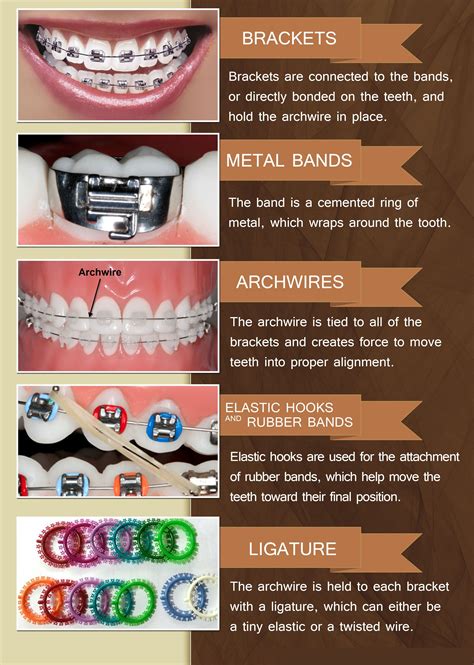 Braces Wire Size Chart