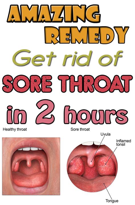 How To Get Rid Of A Sore Throat How To Do It