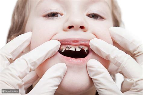 علاج تسوس الأسنان عند الأطفال ليالينا