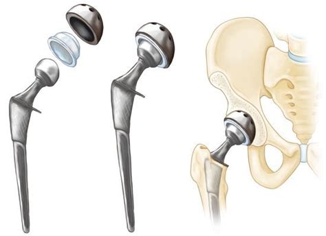 Advances In Total Hip Replacement