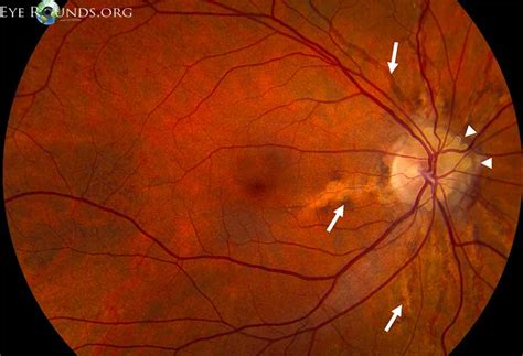Atlas Entry Angioid Streaks And Optic Disc Drusen In Pseudoxanthoma