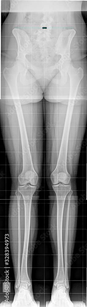 Real Half Body X Ray Scan From Hips To Feet A Female Radiograph