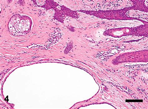 Fibroepithelial Hamartoma In A Domestic Pig W Sipos F Griessler F