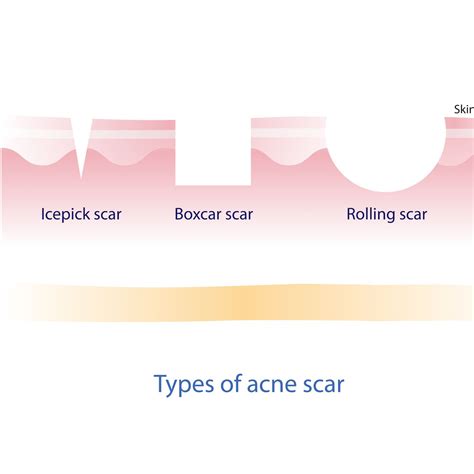 List 99 Pictures Types Of Scars With Images Updated