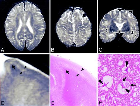 Cerebral Cortical And White Matter Lesions In Chronic Hepatic