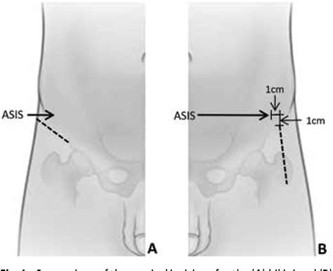 Figure 1 From Bikini Versus Traditional Incision Direct Anterior