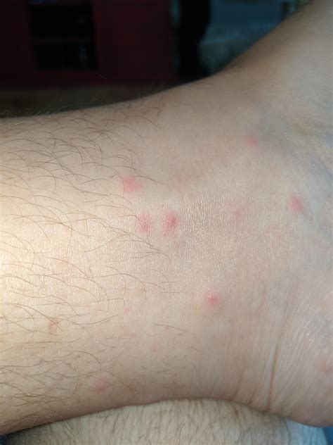 9 Mosquito Bites On My Left Ankle All From Last Night I Am Not A Fan