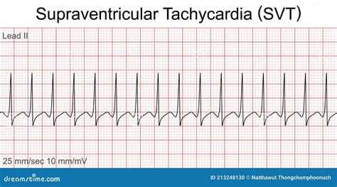 Electrocardiogram Show Supraventricular Tachycardia Svt Pattern Stock