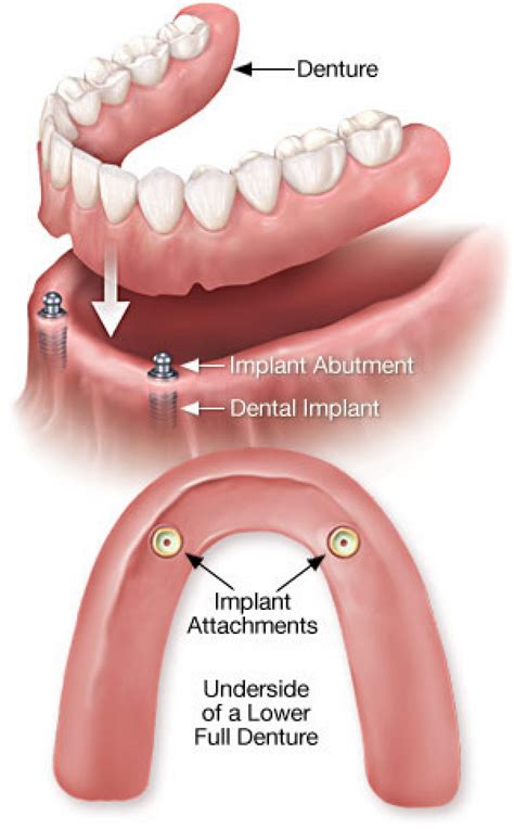 Dental Implants Over Denture Tyler Tx Dr Steven M Oneal Dds