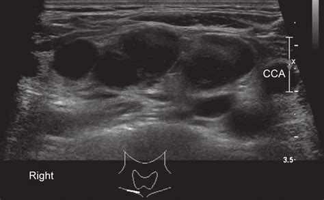 Ultrasound Of Patients Neck Region Revealing Multiple Enlarged Lymph