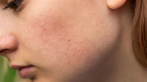 How To Overcome Inflamed And Itchy Acne Netralnews