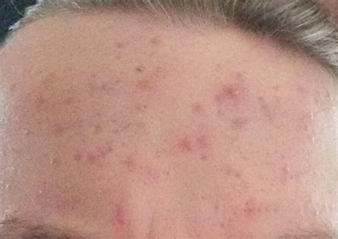 Severe Acne On Forehead Help General Acne Discussion Forum