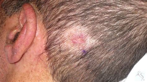 Skin Cancer On Scalp Pictures Mamie Fisher Buzz