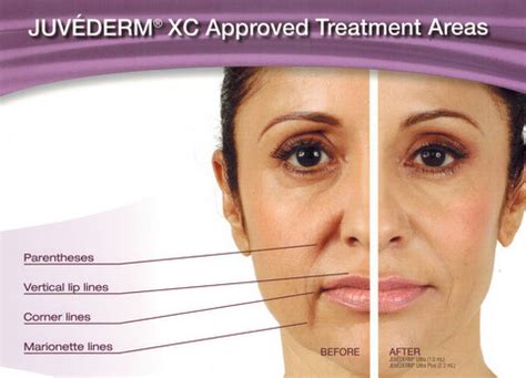 Pictures of gel up with kinky for round face : Dermal Fillers: Restylane & Juvederm - Bella Body Medical Spa