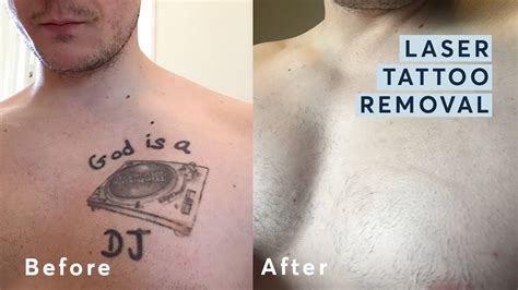 Update More Than Tattoo Removal Before And After Photos Super Hot In Eteachers
