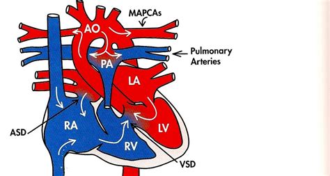 Heart Defects For Everyone Pulmonary Atresia With Major