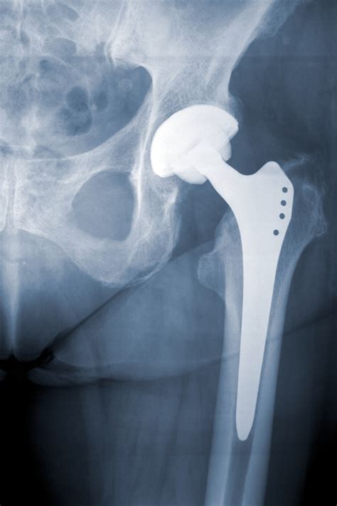 X Ray Of An Artificial Left Hip Joint Of A Large Human Sports