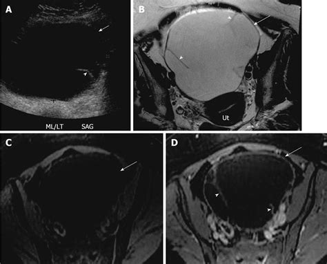 multimodality imaging of ovarian cystic lesions review with an imaging based algorithmic approach