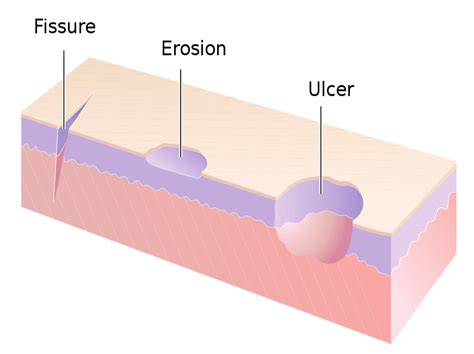 Types Of Wound Ulcers