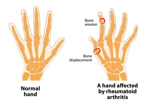 Hand Rheumatoid Arthritis Synexus