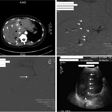 A Abdominal Ct Scan With Intravenous Contrast Demonstrating The Large