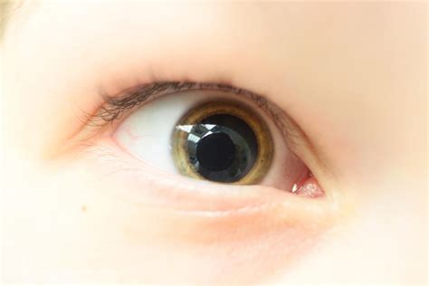 Mydriasis Causes And Treatment For Dilated Pupils