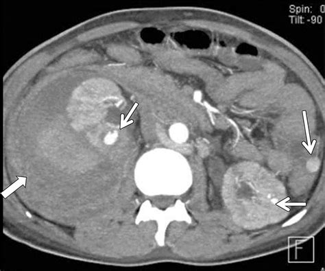 Radiologic Assessment Of Native Renal Vasculature A Multimodality