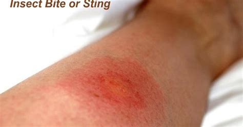 Insect Bites And Stings Health And Medical Information